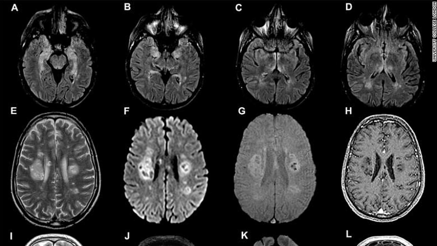 סריקות מוח של חולי ומחלימי קורונה שסבלו מנזקים נוירולוגיים. צילום מתוך מחקר של יוניברסיטי קולג' בבריטניה