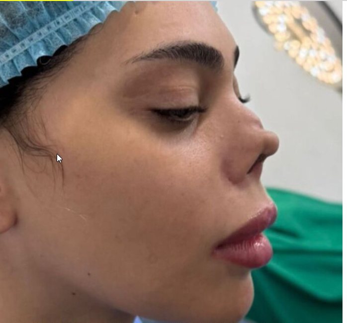 ניתוח האף של רומי שנכשל