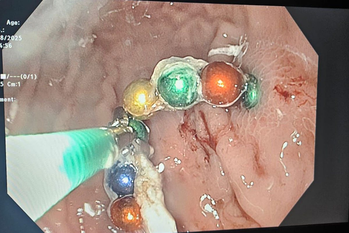 המגנטים בתוך בטנו של הפעוט