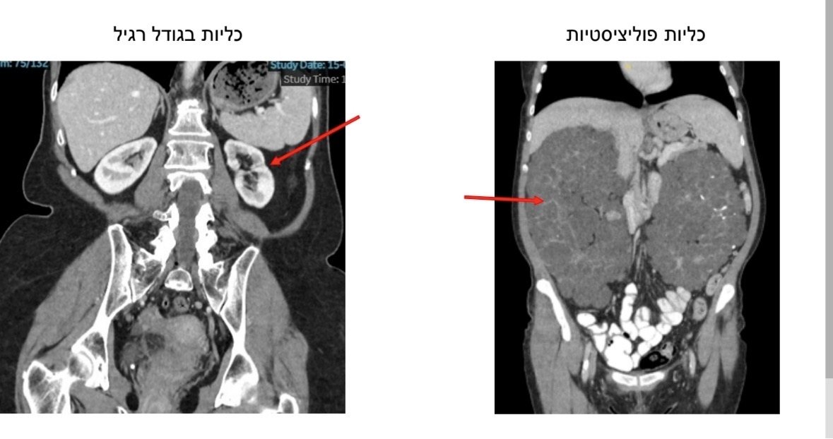הכליות של שבלה מימין, לעומת כליות בגודל תקין משמאל.