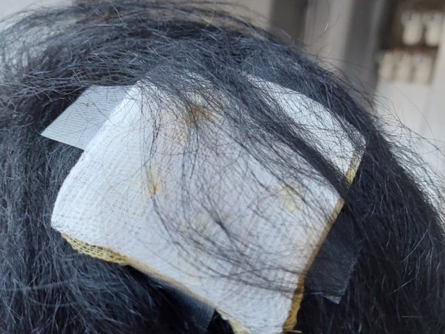 הפציעה בראשה של התושבת